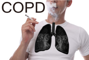 その息苦しさは肺気腫（COPD）が原因!?知っておくべき7つの事実