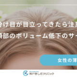 分け目が目立ってきたら注意｜頭頂部のボリューム低下のサイン