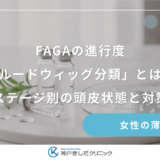 FAGAの進行度「ルードウィッグ分類」とは？ステージ別の頭皮状態と対策