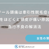 ポニーテール頭痛は牽引性脱毛症の前兆？髪をほどくと頭皮が痛い原因と血行不良の解消法