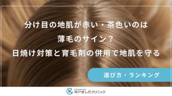 分け目の地肌が赤い・茶色いのは薄毛のサイン？日焼け対策と育毛剤の併用で地肌を守る
