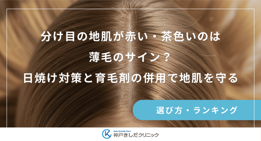 分け目の地肌が赤い・茶色いのは薄毛のサイン？日焼け対策と育毛剤の併用で地肌を守る