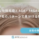 びまん性脱毛症とAGA・FAGAの違い｜抜け毛のパターンで見分ける特徴