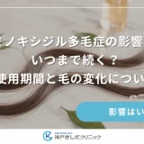 ミノキシジル多毛症の影響はいつまで続く?使用期間と毛の変化について