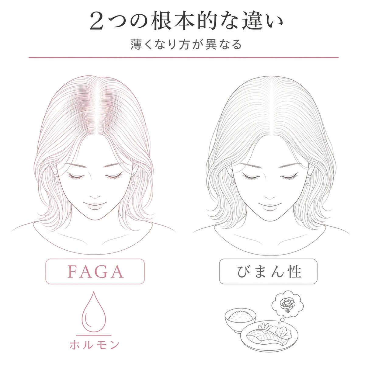 頭頂部から薄くなるFAGAと全体が均一に薄くなるびまん性脱毛症の違いを比べた線画イラスト