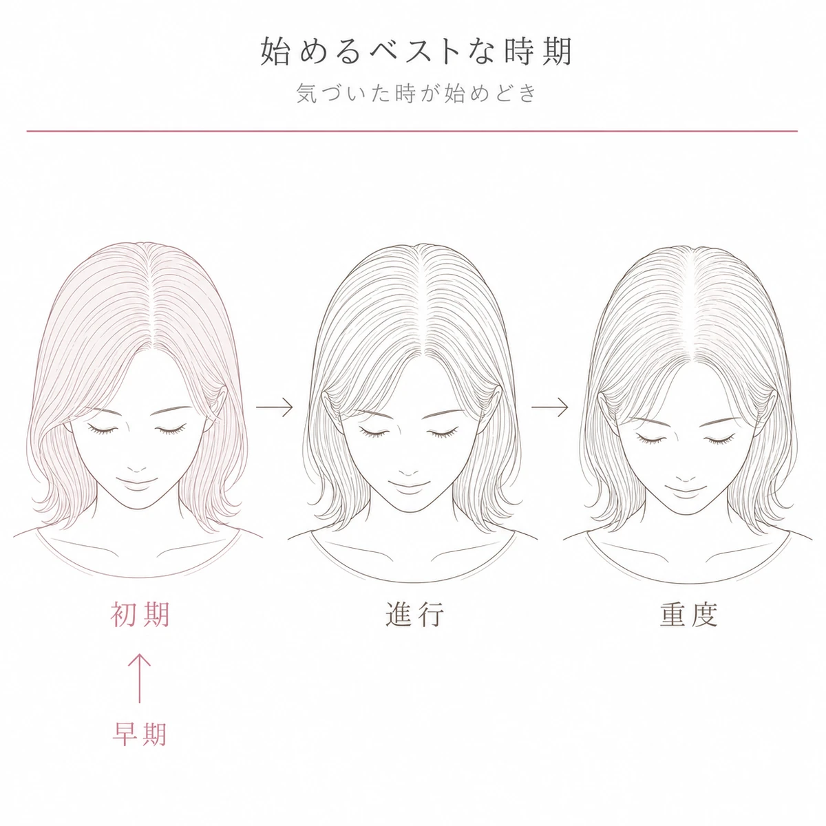 初期のうちに始めるほど回復しやすい薄毛治療のタイミングを段階で表した線画イラスト