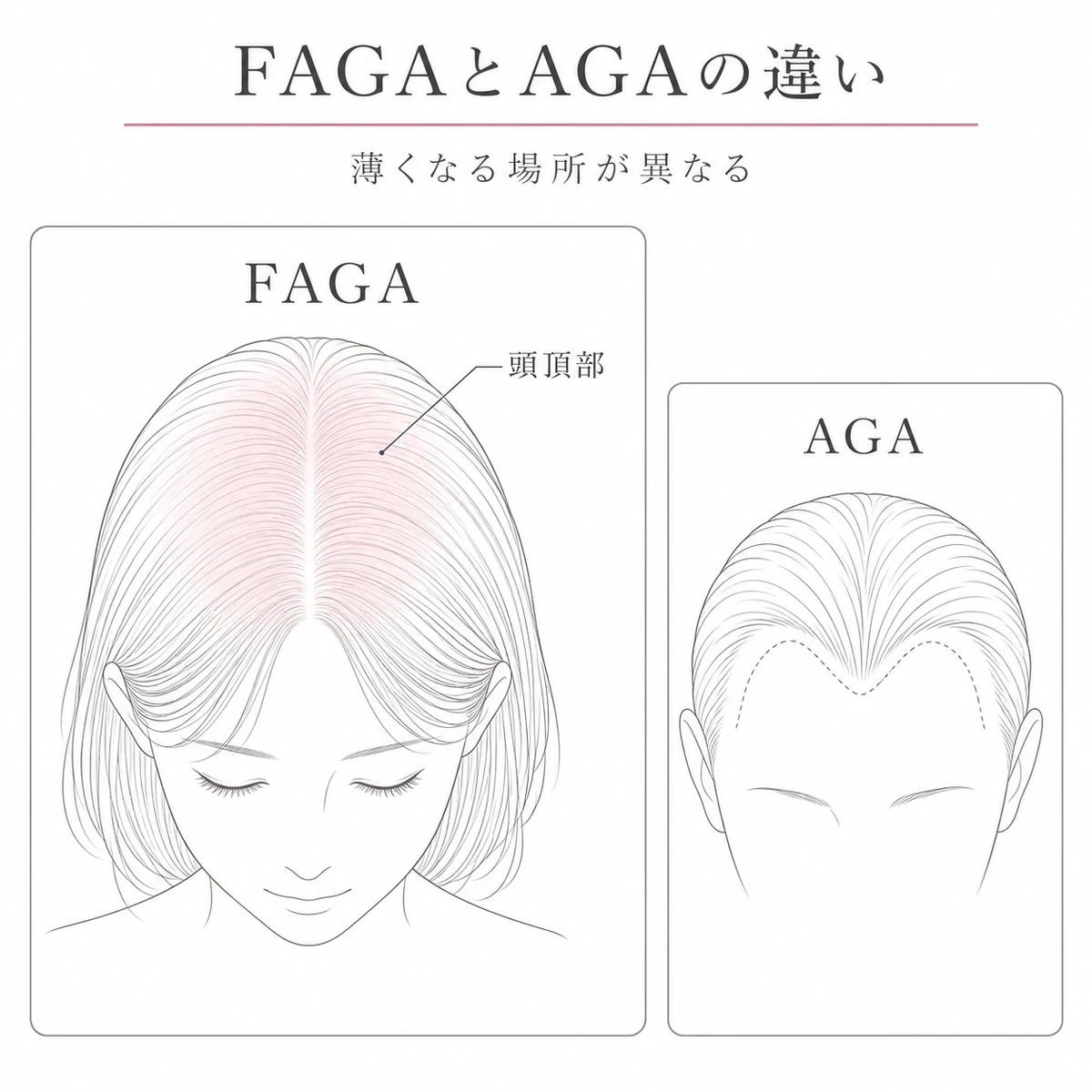 頭頂部全体が薄くなる女性のFAGAと生え際が後退する男性のAGAの違いを左右で比べた線画イラスト