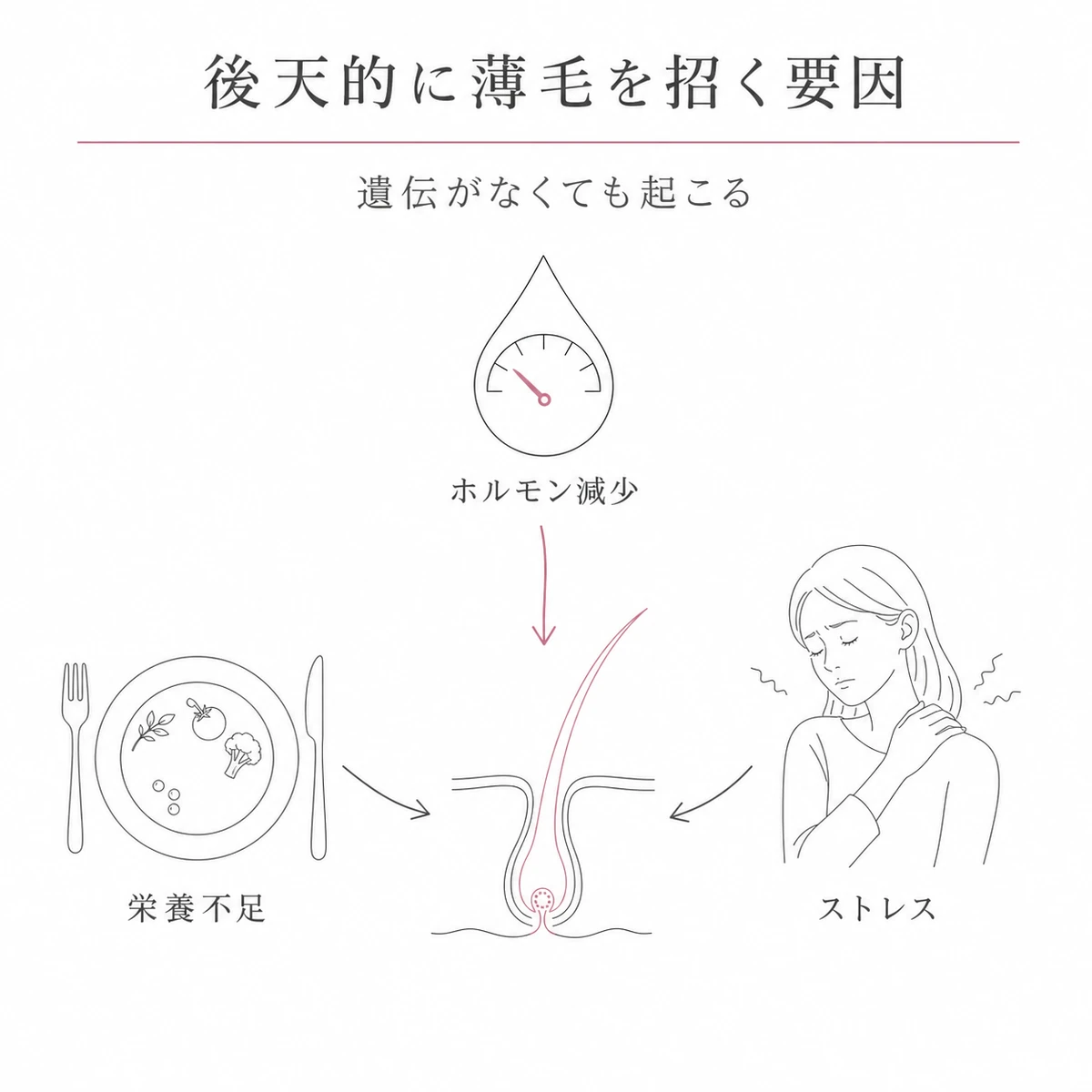 ホルモン減少とストレスと栄養不足が薄毛を加速させる後天的な要因を相関図で表した線画イラスト