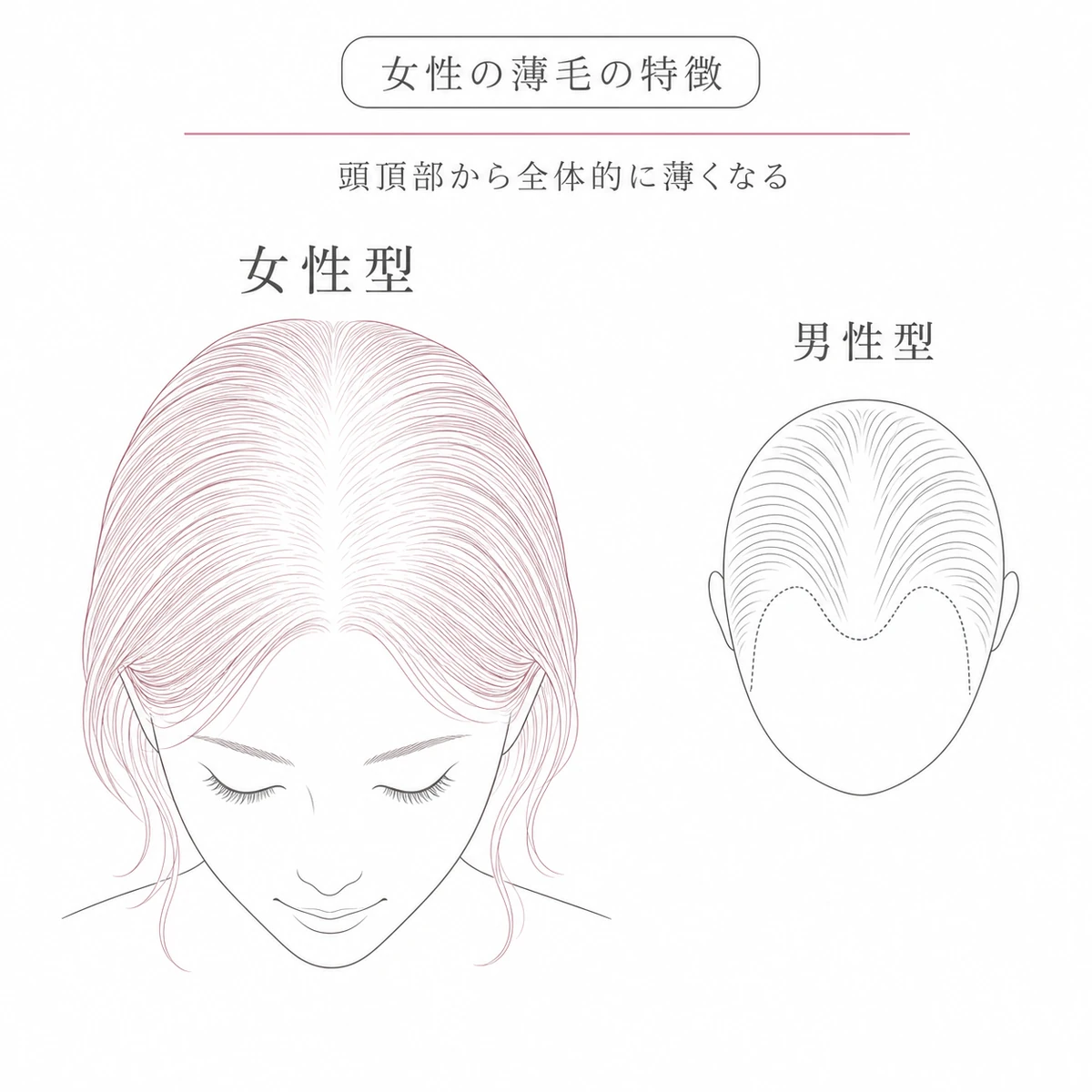 頭頂部から薄くなる女性型と生え際が後退する男性型の薄毛パターンの違いを比べた線画イラスト