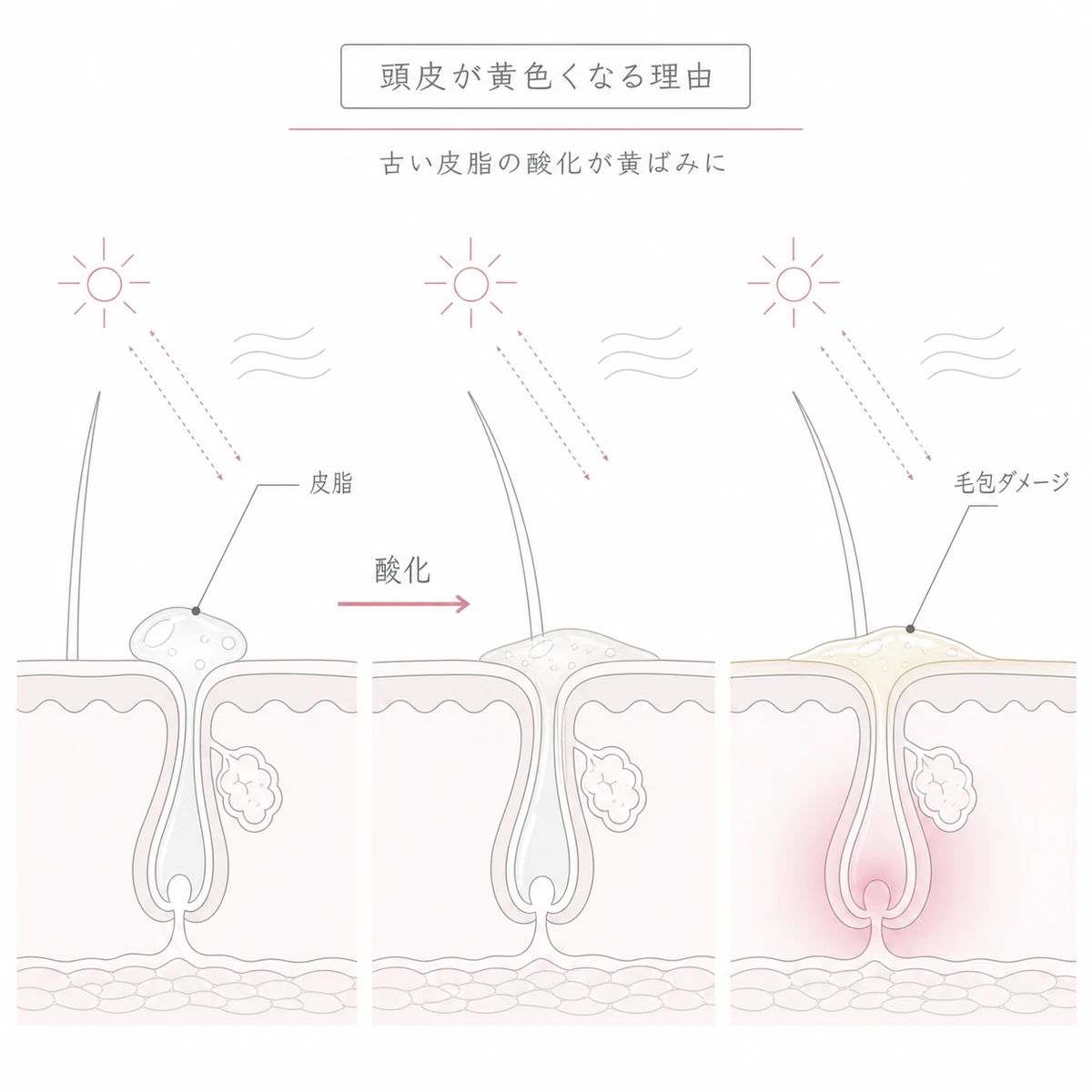 透明な皮脂が紫外線と空気で酸化し黄色い過酸化脂質となって毛包を刺激する頭皮断面の線画イラスト