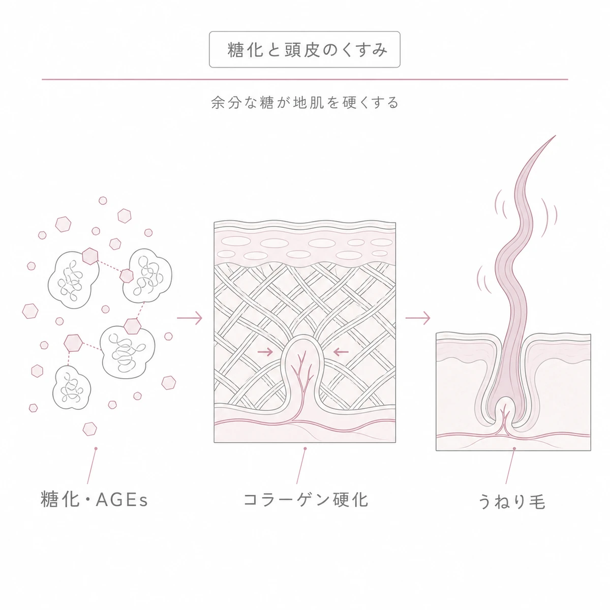 糖化で生じたAGEsがコラーゲンを硬くしうねり毛を招くまでの流れを左から右へ表した線画イラスト