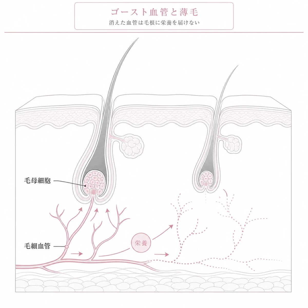 消えかけた毛細血管が毛母細胞へ栄養を届けられず抜け毛を招く関係を表した線画イラスト
