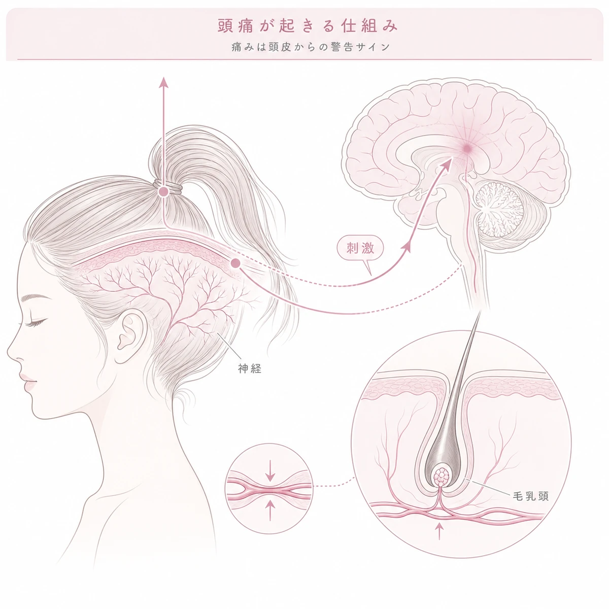 ポニーテールの牽引が頭皮の神経を刺激して痛みが生じる仕組みを表した線画イラスト