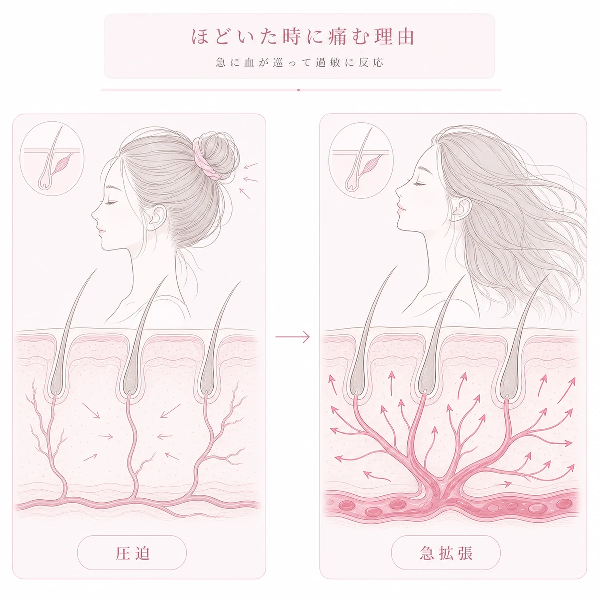 髪をほどいた瞬間に頭皮の血管が急に広がり痛みが走る理由を表した線画イラスト