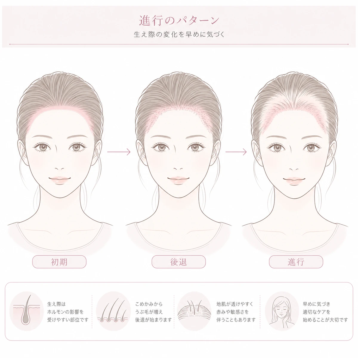 生え際が段階的に後退していく牽引性脱毛症の進行パターンを表した線画イラスト