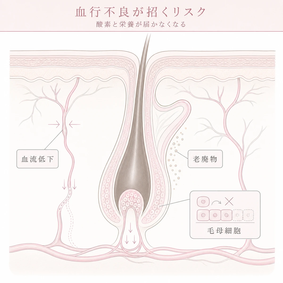 牽引で毛細血管が圧迫され毛根へ酸素が届かなくなる血行不良のリスクを表した線画イラスト