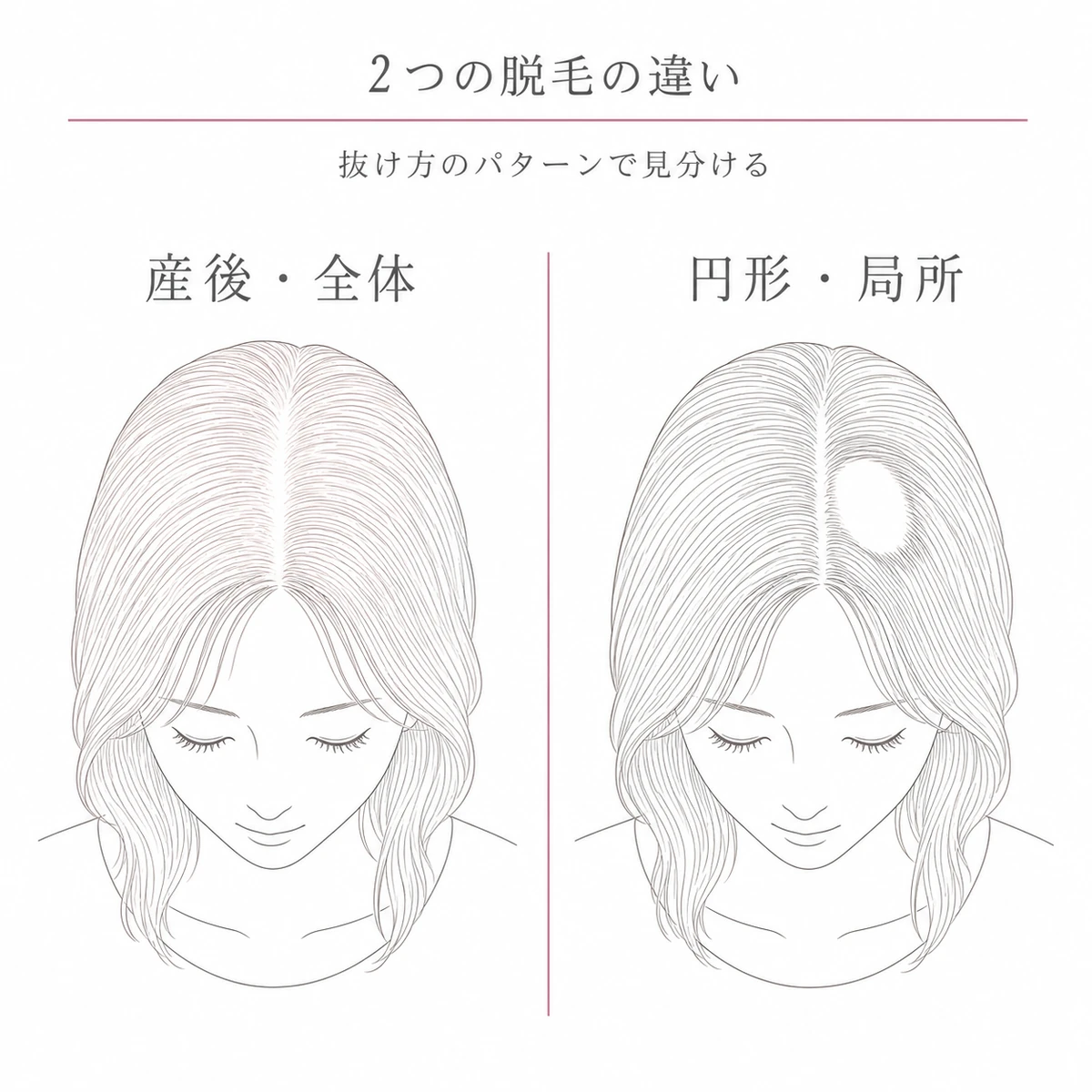 全体的に薄くなる産後の抜け毛と丸い脱毛斑ができる円形脱毛症の抜け方の違いを対比した線画イラスト