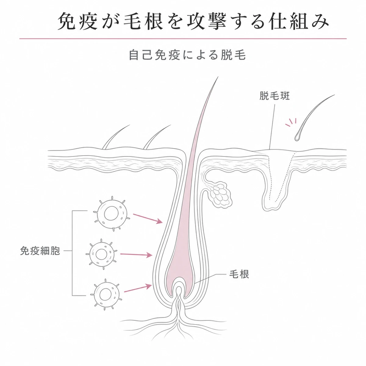 免疫細胞が毛根を攻撃して円形脱毛症が起こる仕組みを毛包の断面で表した線画イラスト