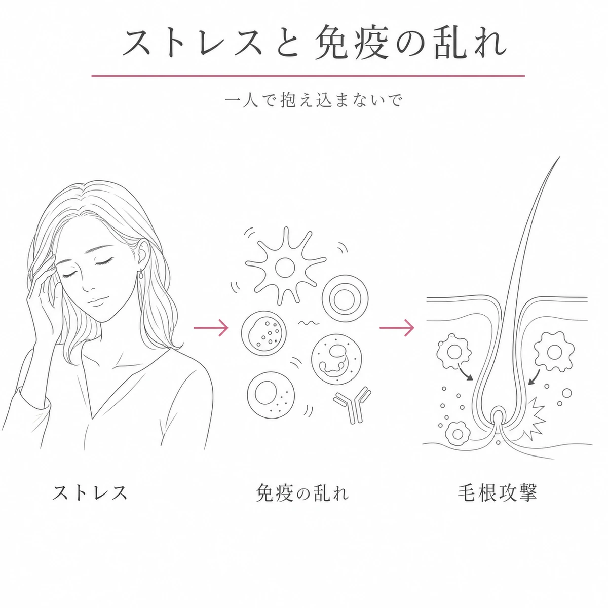 産後のストレスが免疫を乱し間接的に毛根攻撃を招く流れを表した線画イラスト