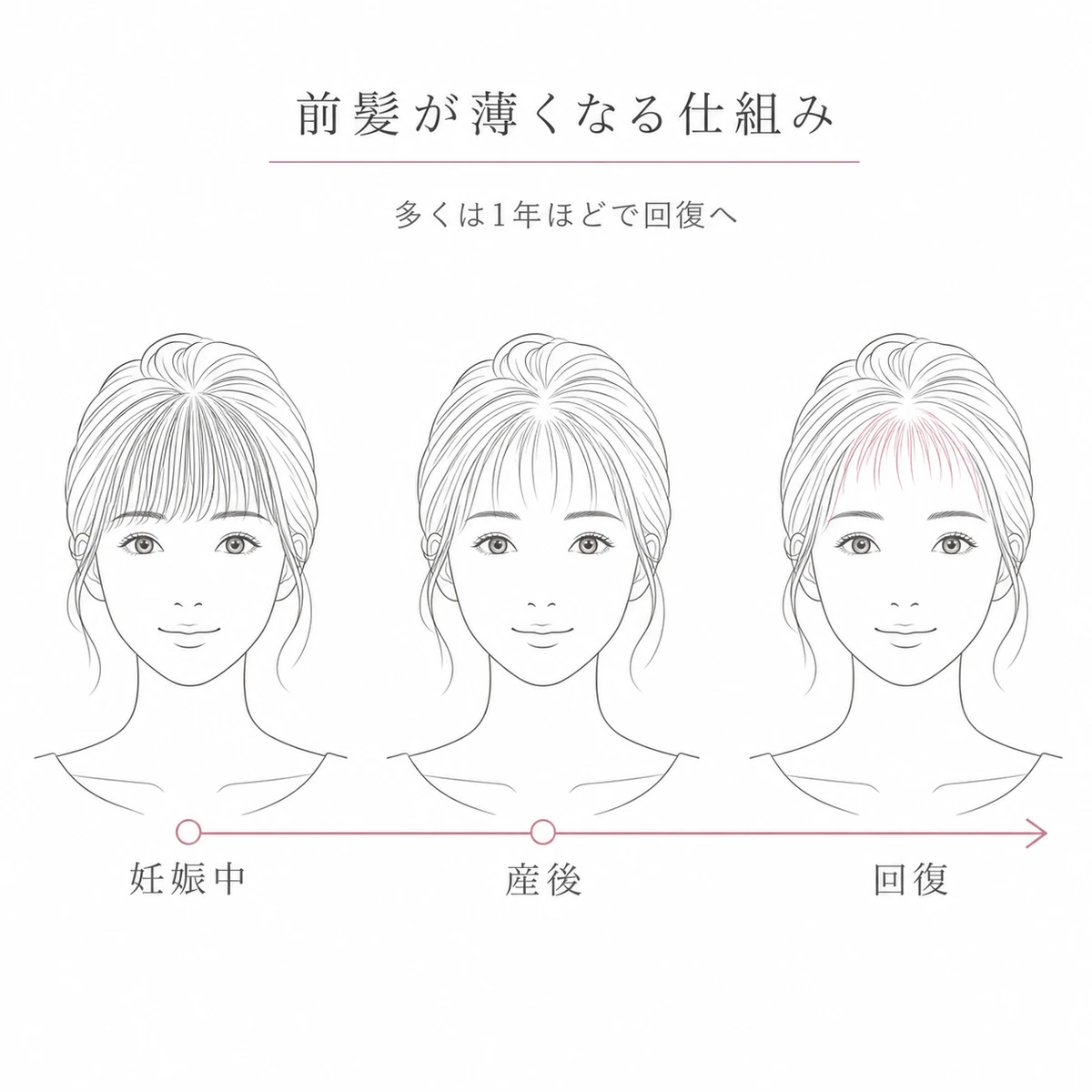 妊娠中から産後を経て前髪が回復していく変化を女性の前髪で表した線画イラスト