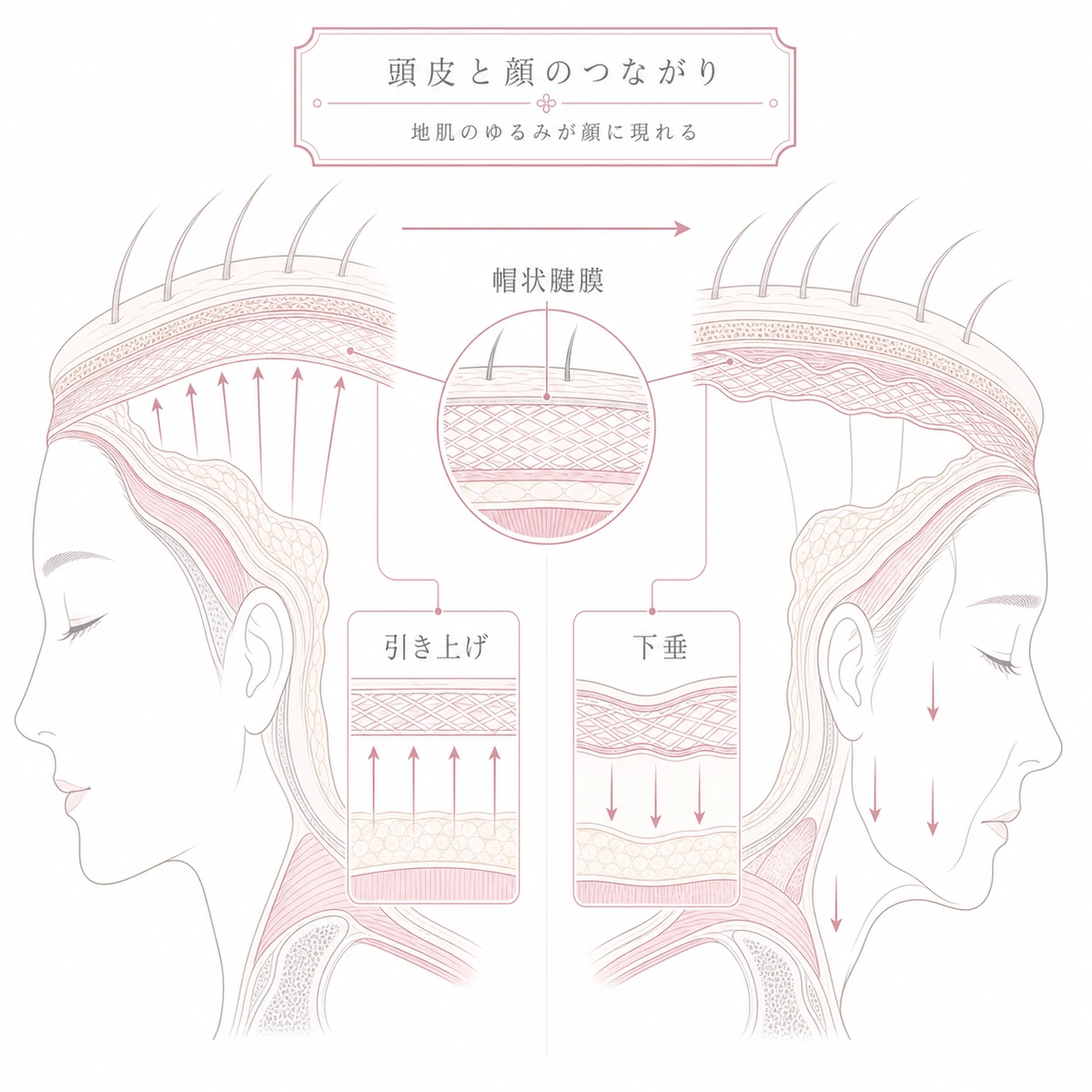 頭皮の帽状腱膜がゆるむと顔が下垂する頭皮と顔のつながりを表した線画イラスト