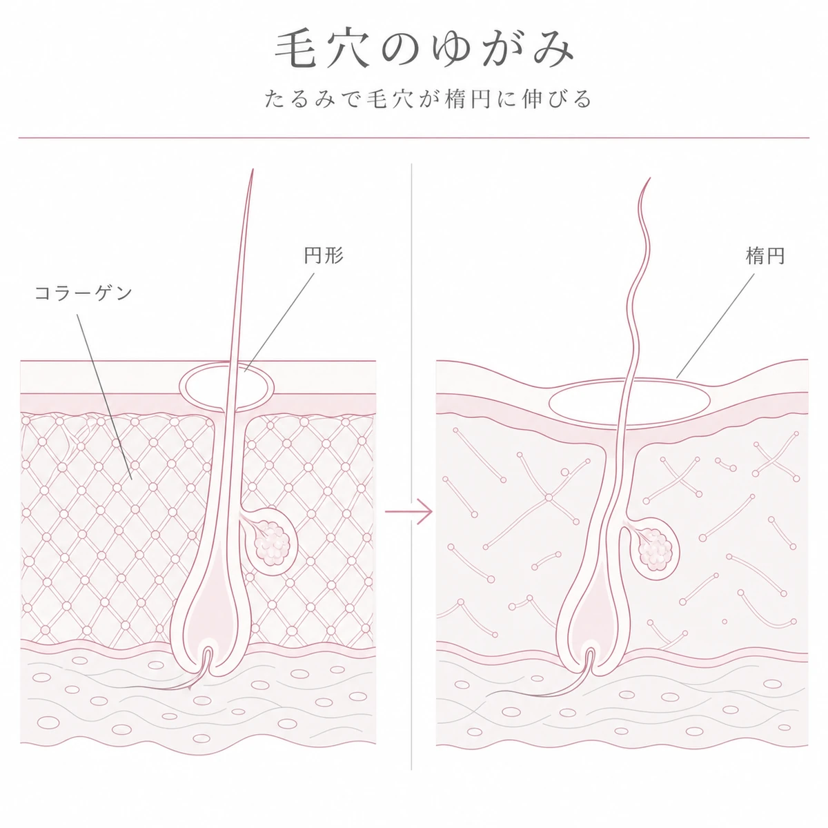 真皮のコラーゲン減少で毛穴が円形から楕円に歪み髪がうねる変化を対比した線画イラスト