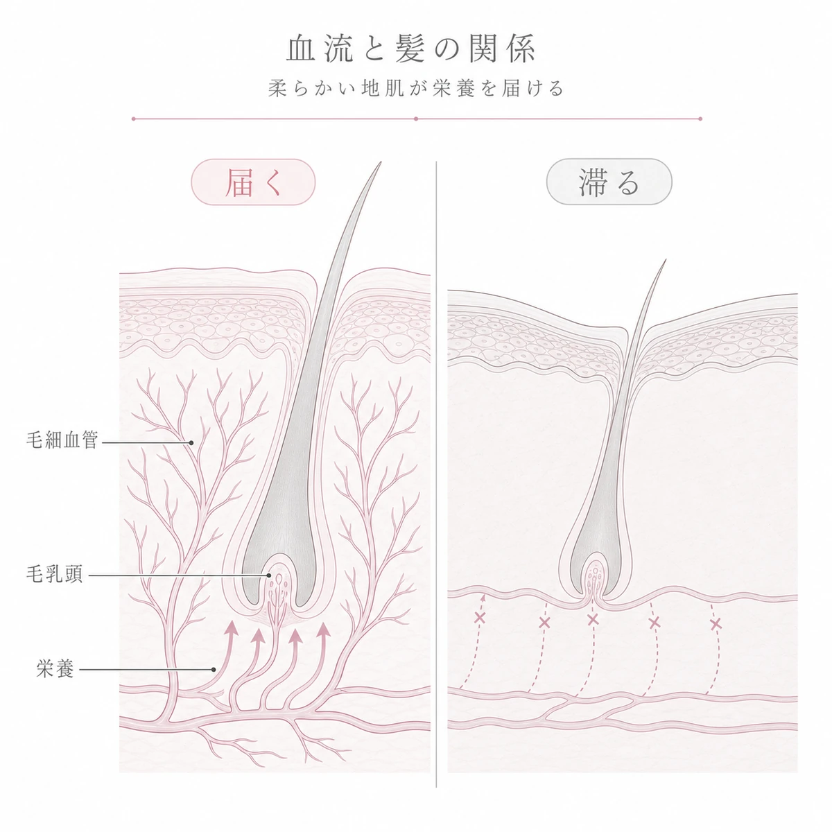 柔らかい頭皮では血流が毛乳頭へ届きたるむと栄養が滞る仕組みを対比した線画イラスト
