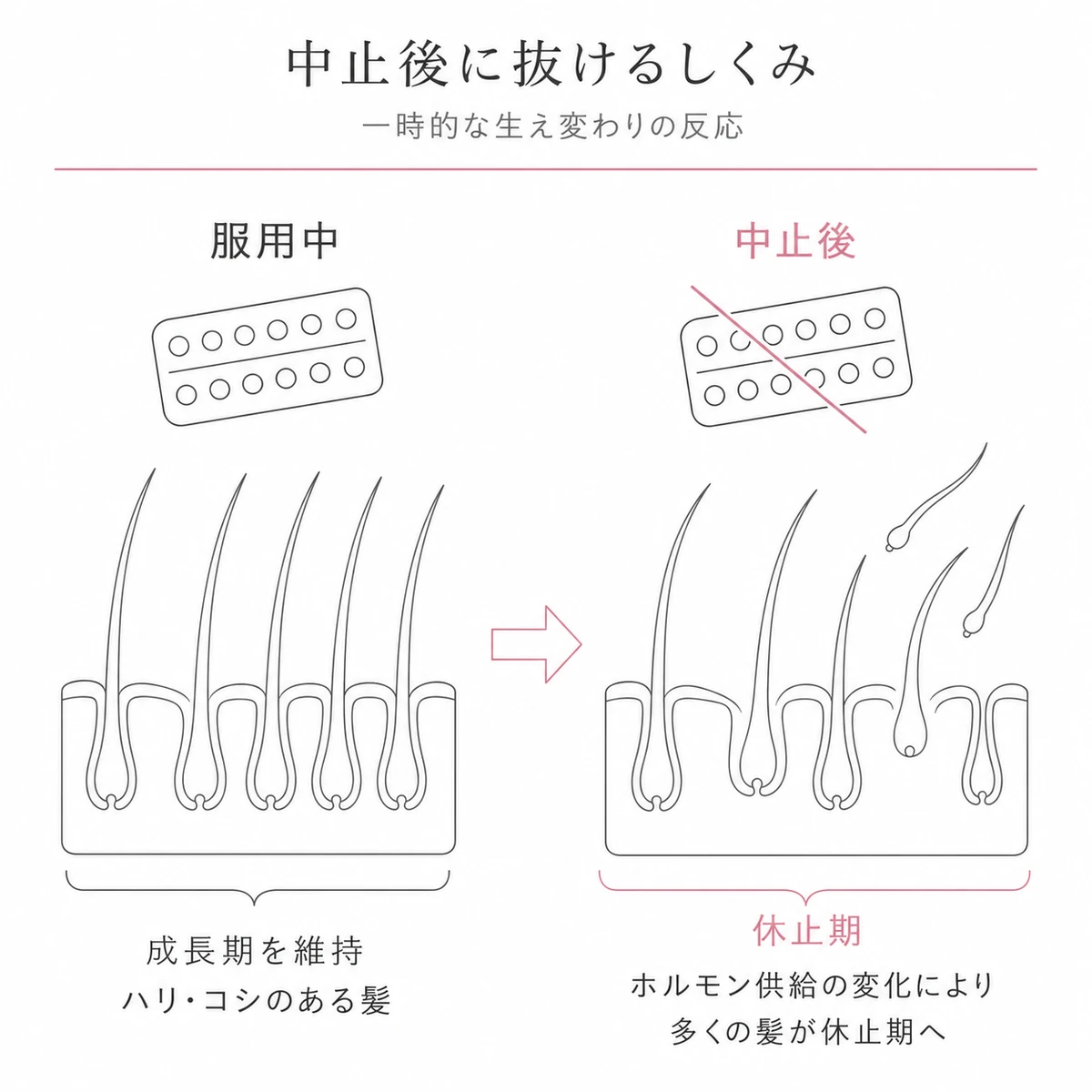 ピル服用中と中止後で髪が一斉に休止期へ移る変化を対比した線画イラスト