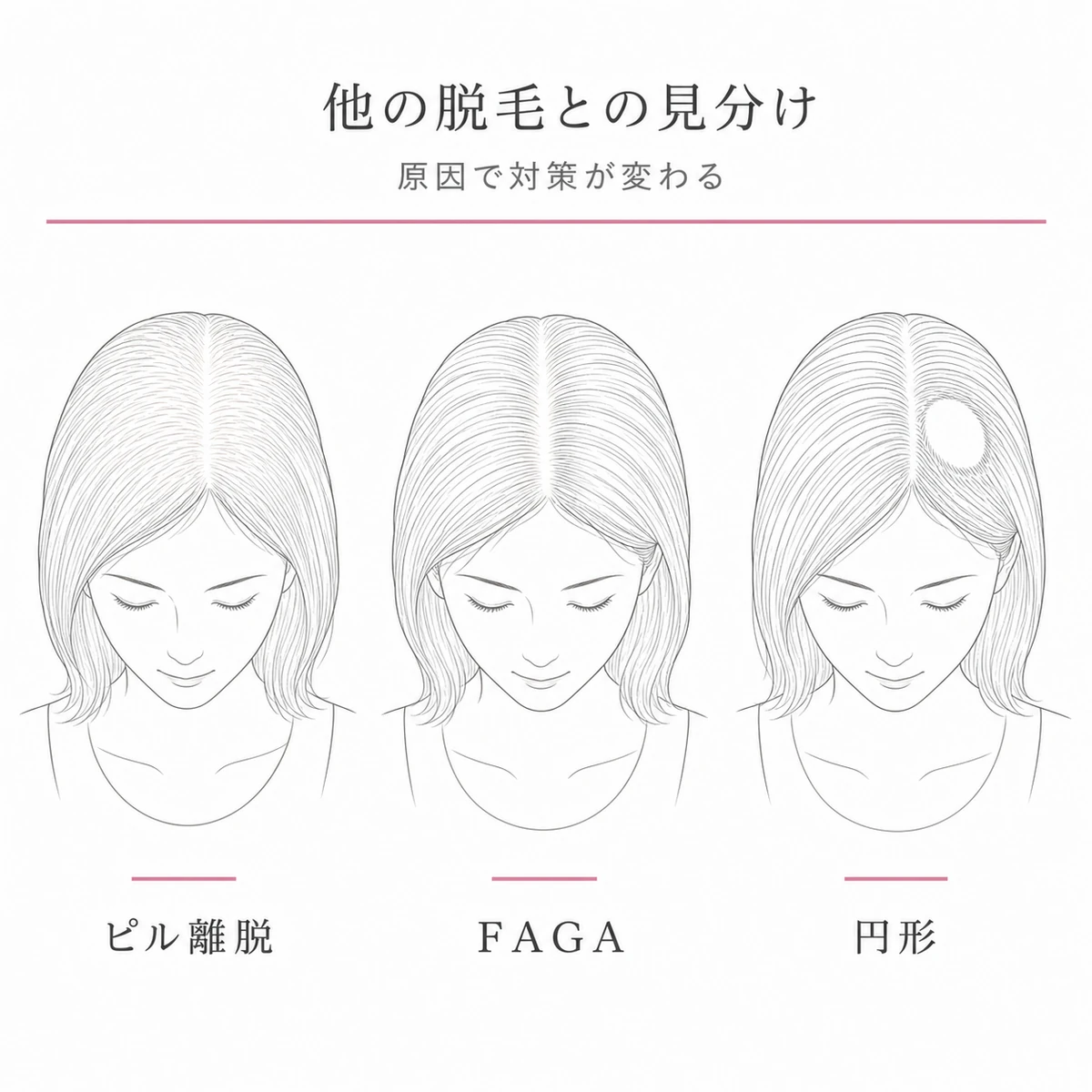 ピル離脱・FAGA・円形脱毛の抜け方の違いを3つの女性の頭で比べた線画イラスト