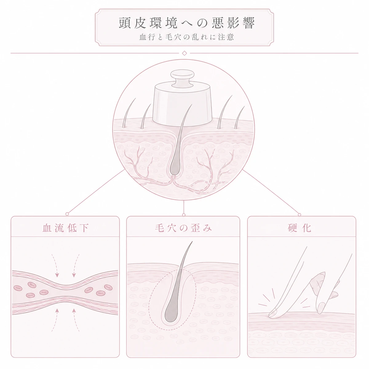 重みで血流が低下し毛穴が歪み頭皮が硬くなる悪影響を表した線画イラスト