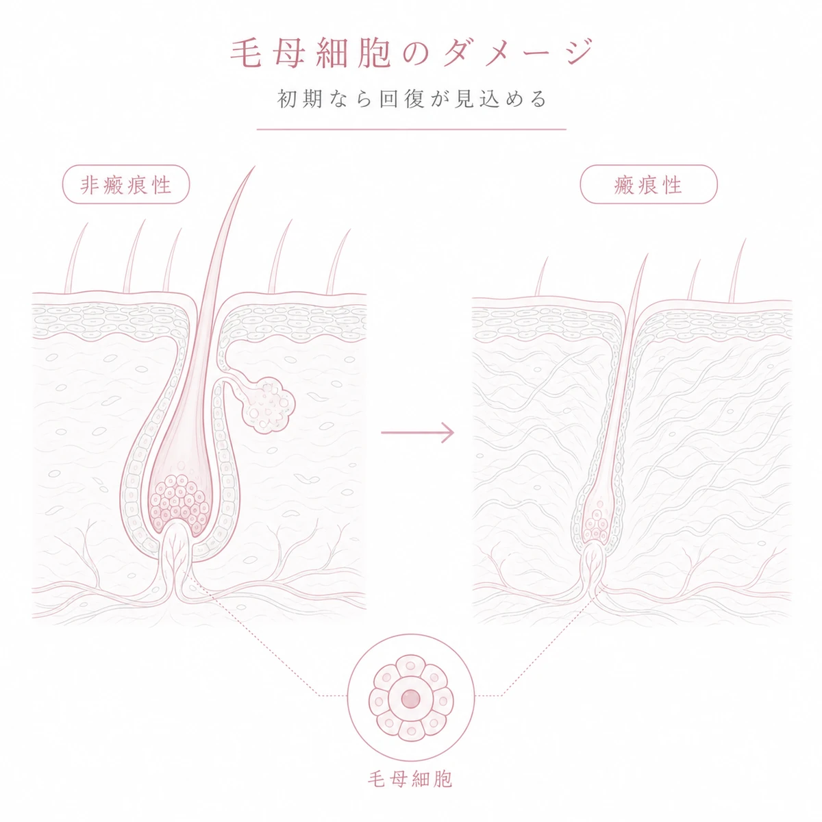 非瘢痕性から瘢痕性へ毛包が萎縮する毛母細胞のダメージを表した線画イラスト