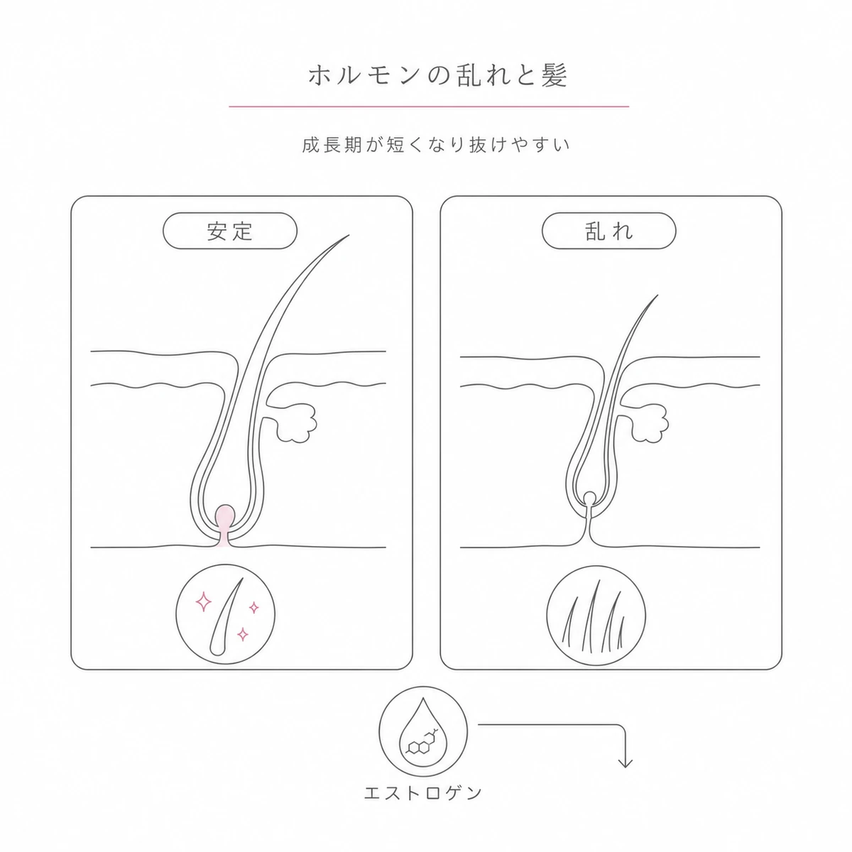 エストロゲンの乱れで髪の成長期が短くなり細く弱くなる変化を対比した線画イラスト