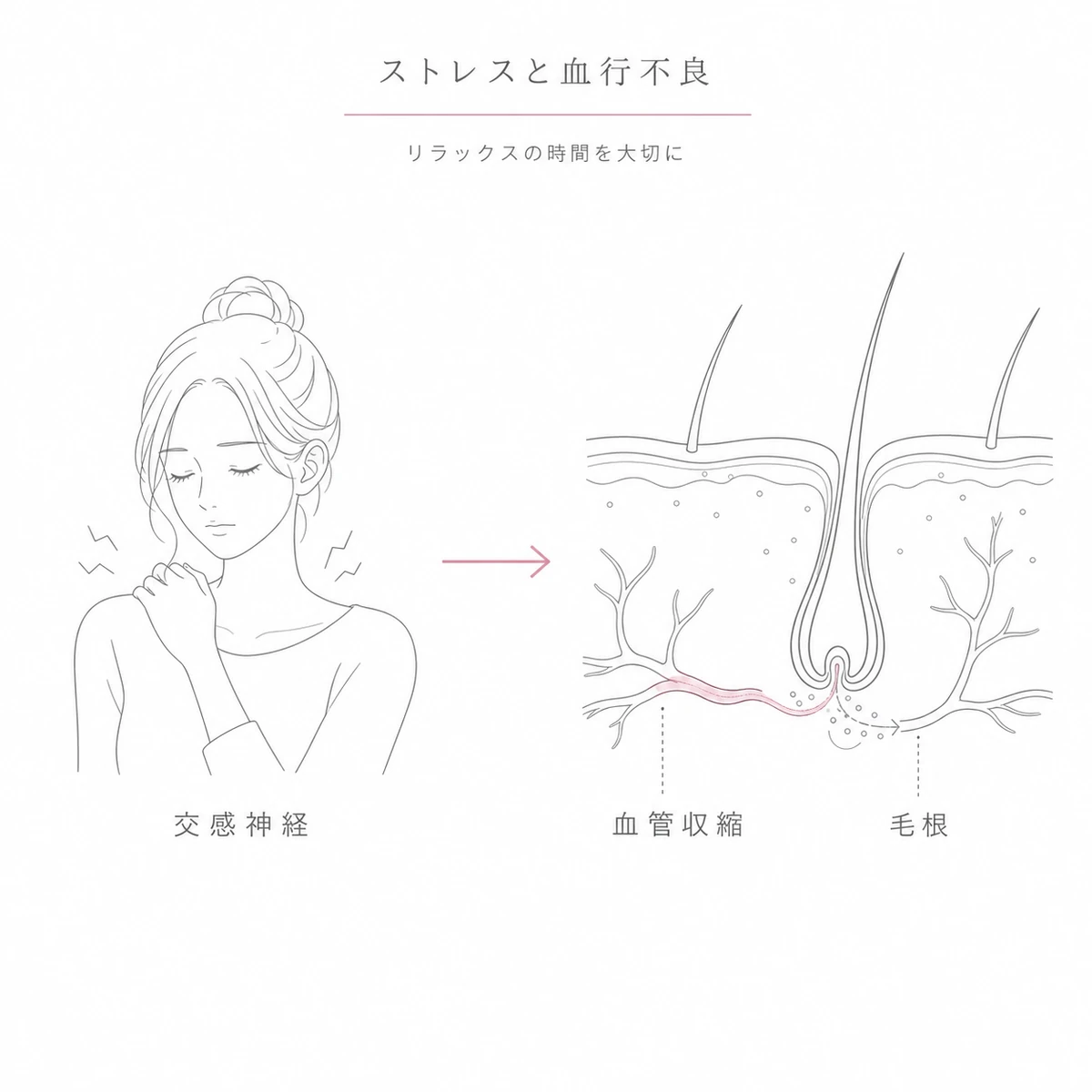 ストレスによる交感神経の緊張が頭皮の血管を収縮させ毛根の栄養を妨げる流れを表した線画イラスト
