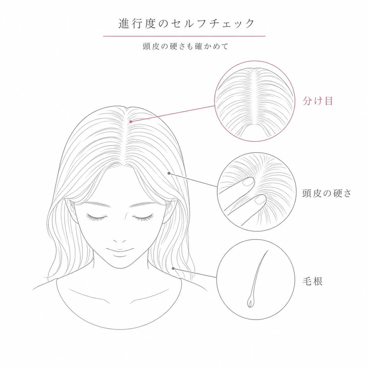分け目の広がりと頭皮の硬さと抜け毛の毛根を確かめる進行度セルフチェックの要点を表した線画イラスト