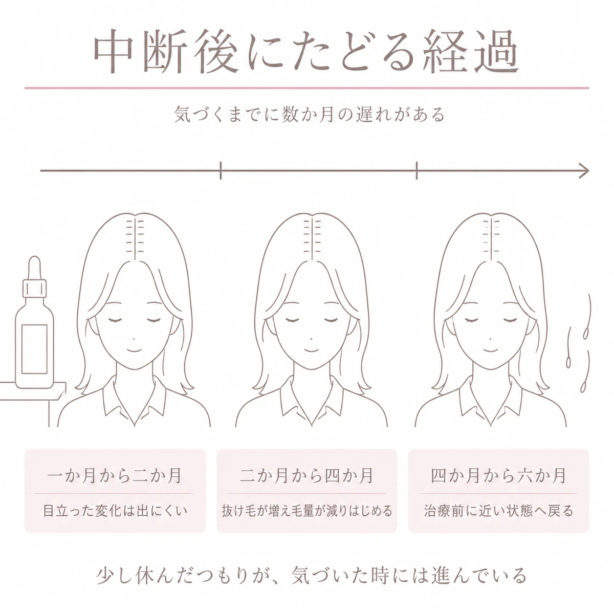 育毛剤をやめてから数か月かけて毛量が減っていく経過を時間の矢印と三つの頭部で並べたイラスト