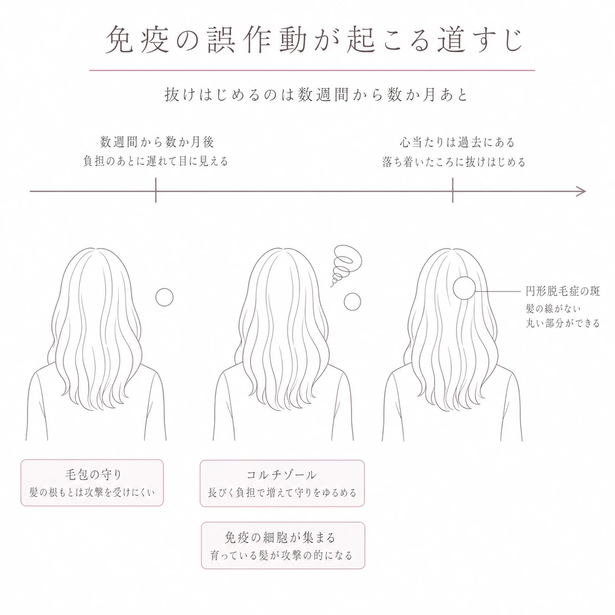 ストレスで免疫の守りがゆるみ数か月遅れて円形脱毛症の斑があらわれる流れを表した線画イラスト