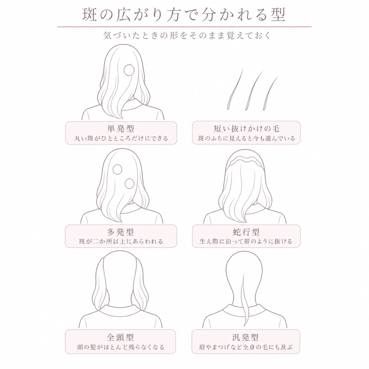 円形脱毛症の単発型や多発型や蛇行型など広がり方の違う型を頭部の輪郭で三段に並べた線画イラスト