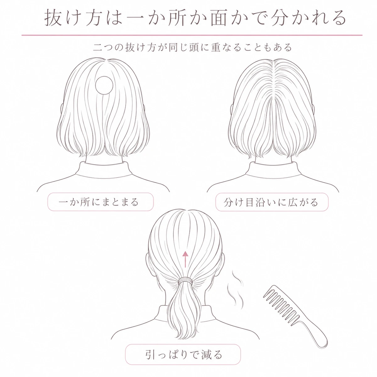 一か所にまとまる抜け方と分け目沿いの薄さ、引っぱりで減る生え際を並べた図解イラスト