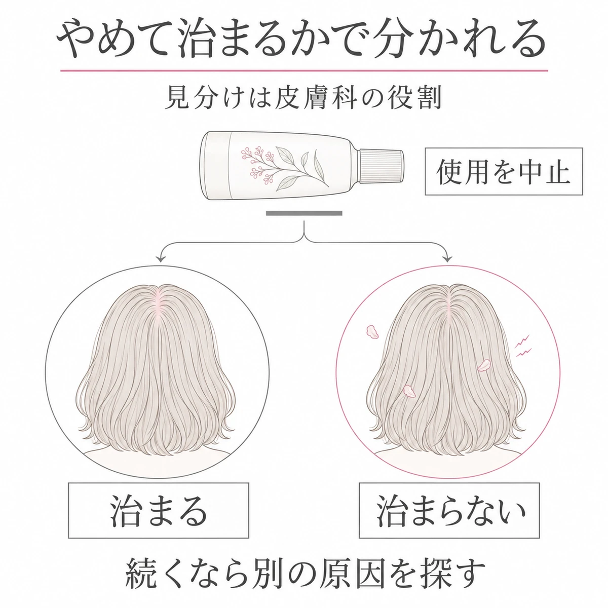 育毛剤の使用中止後に頭皮症状が治まる場合と、乾燥や薄片が残る場合に分かれる図
