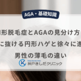 円形脱毛症とAGAの見分け方！急に抜ける円形ハゲと徐々に進む男性の薄毛の違い