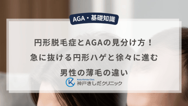 円形脱毛症とAGAの見分け方！急に抜ける円形ハゲと徐々に進む男性の薄毛の違い