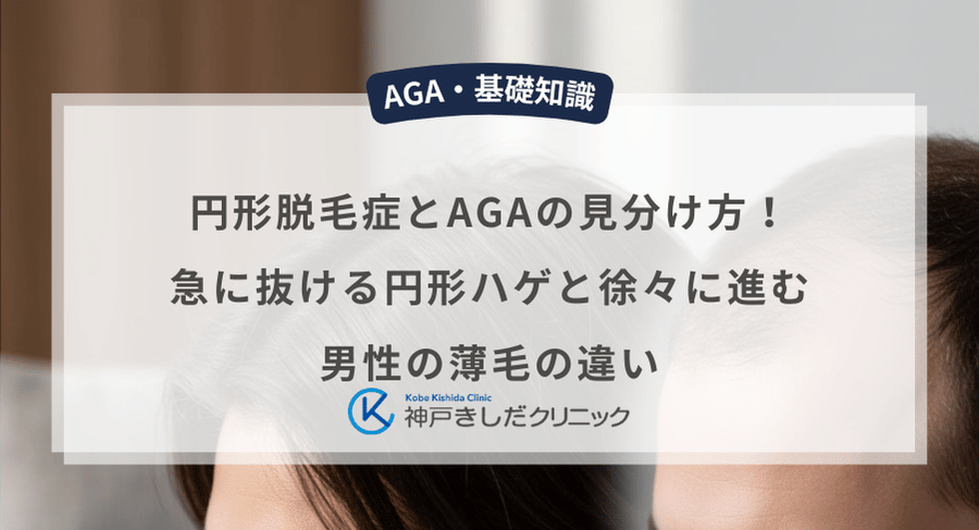 円形脱毛症とAGAの見分け方!急に抜ける円形ハゲと徐々に進む男性の薄毛の違い