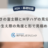 生まれつきの富士額とM字ハゲの見分け方は？男性の生え際の角度と形で見極める基準