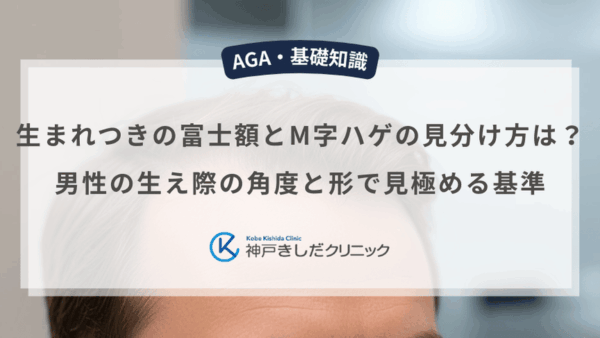 生まれつきの富士額とM字ハゲの見分け方は？男性の生え際の角度と形で見極める基準