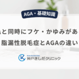 抜け毛と同時にフケ・かゆみがある原因｜脂漏性脱毛症とAGAの違い