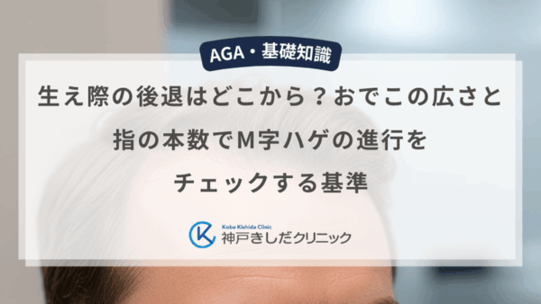 生え際の後退はどこから？おでこの広さと指の本数でM字ハゲの進行をチェックする基準