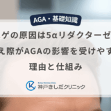 M字ハゲの原因は5αリダクターゼII型？生え際がAGAの影響を受けやすい理由と仕組み