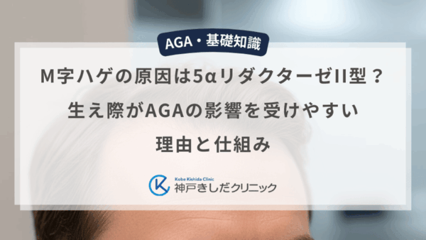 M字ハゲの原因は5αリダクターゼII型？生え際がAGAの影響を受けやすい理由と仕組み