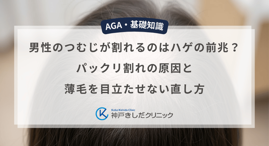 男性のつむじが割れるのはハゲの前兆?パックリ割れの原因と薄毛を目立たせない直し方