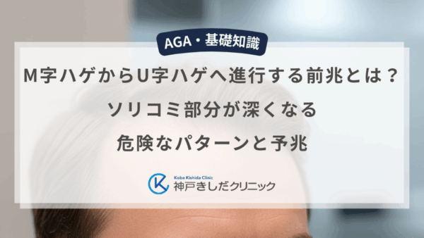 M字ハゲからU字ハゲへ進行する前兆とは？ソリコミ部分が深くなる危険なパターンと予兆